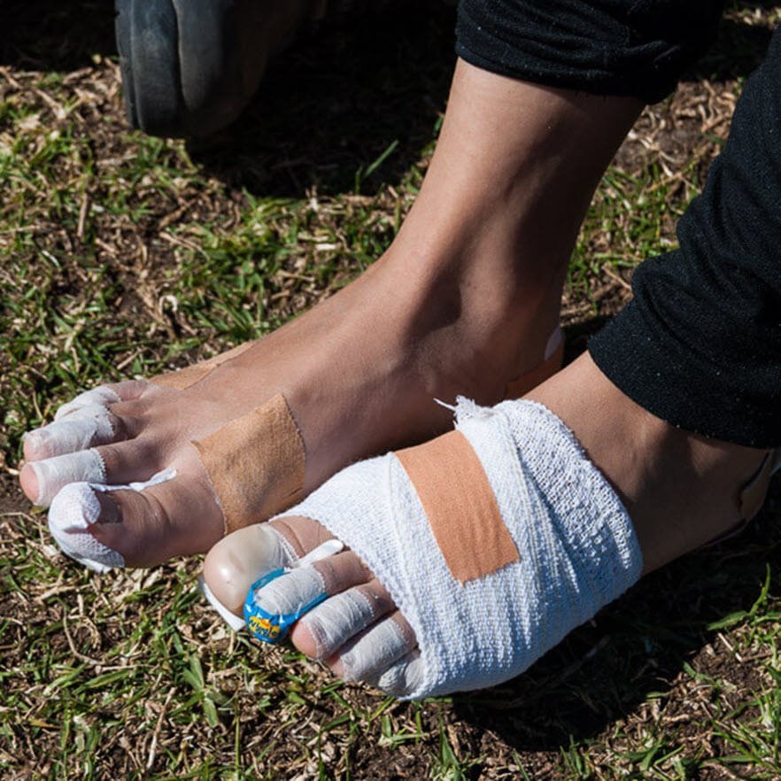 882-blister-prone-feet-bandaged.jpg